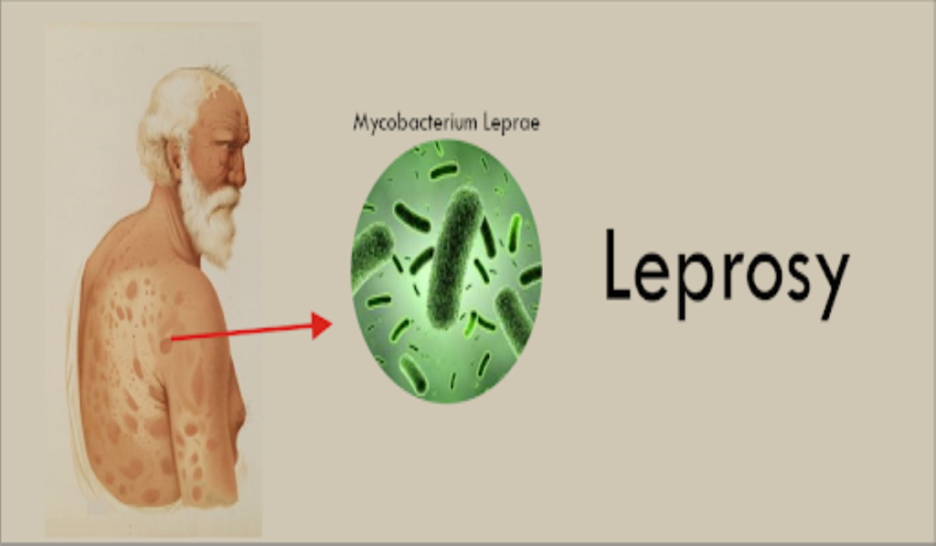 True! Leprosy spreads through respiratory droplets and face masks help curb its spread - Dubawa